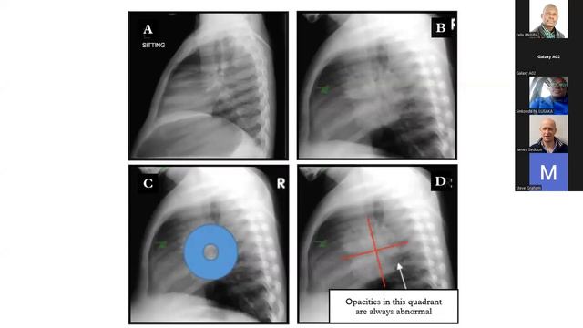 The role of chest X-ray TB in diagnosis, treatment and prevention of TB in children and adolescents смотреть онлайн