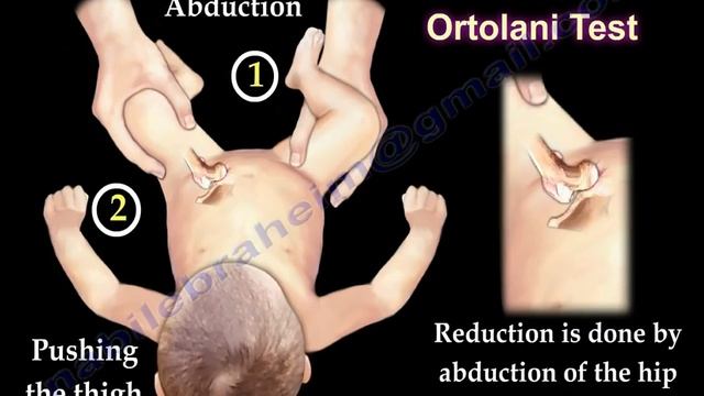 #Barlow And #Ortoalani Signs-DDH#CongenitalHipDislocation!!!!