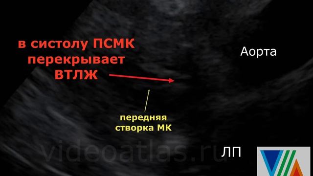 Подклапанный стеноз Ао. Другой вариант. смотреть онлайн