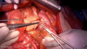 Кишечные анастомозы после мультивисцеральной резекции