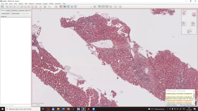 Острое клеточное отторжение трансплантированной печени смотреть онлайн