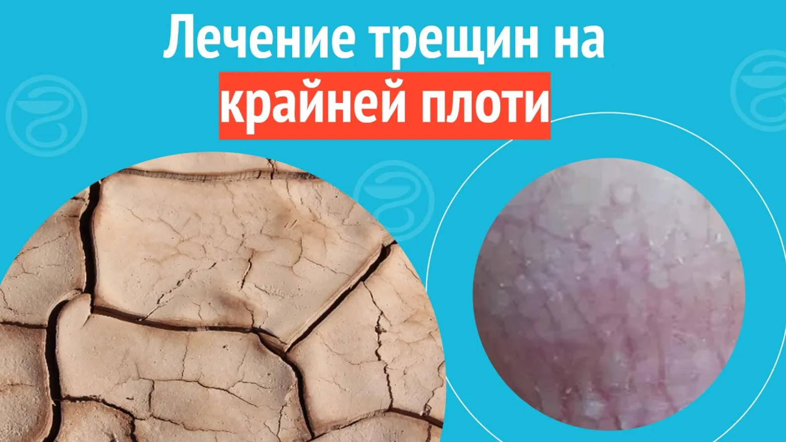 ? Лечение трещин на крайней плоти. Клинический случай №1103 смотреть онлайн