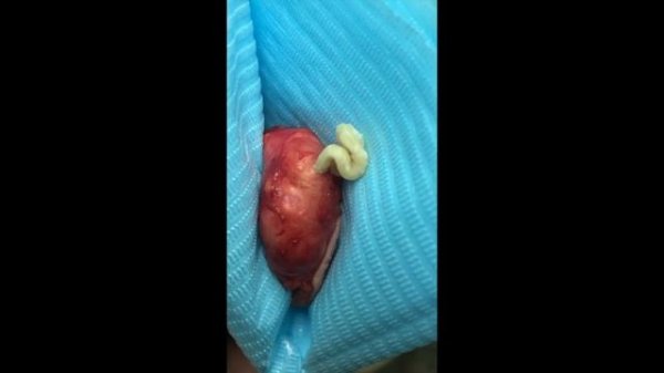 Содержимое атеромы. Атероматозные массы. После удаления..mp4