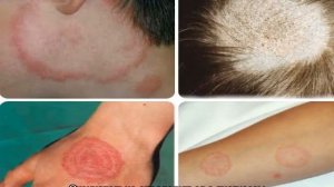 Лишай от кошки у человека: как передается