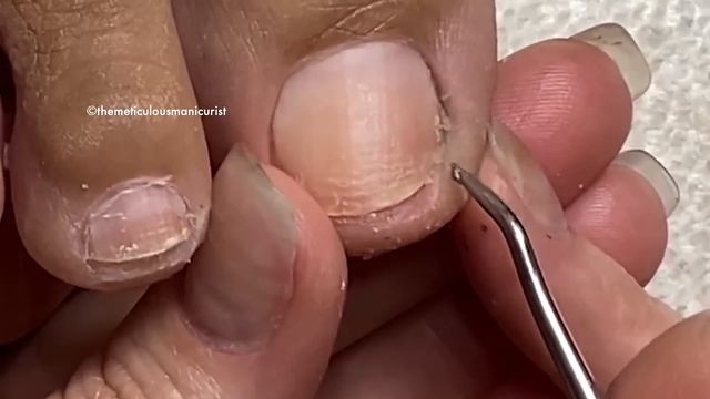 ?Tools for INGROWN TOENAILS & How to Prevent? смотреть онлайн
