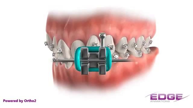Эффективное исправление прикуса, зубы до и после смотреть онлайн