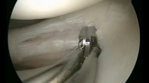 Горизонтальный разрыв заднего рога латерального мениска - артроскопическая техника резекции