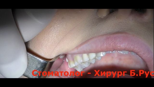 Удаление зуба мудрости на верхней челюсти смотреть онлайн