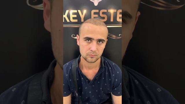 Хороший результат #пересадкаволос смотреть онлайн