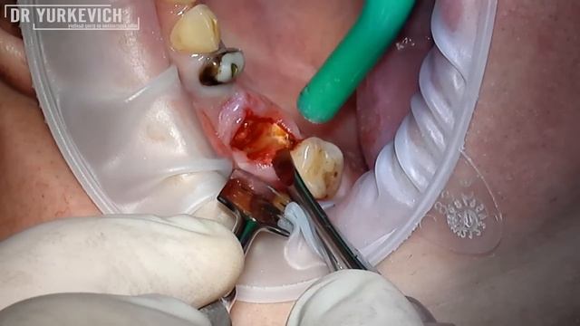 Сложное удаление зуба с кистой (верхний второй моляр) с фрагментированием смотреть онлайн