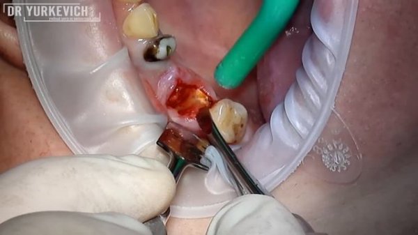 Сложное удаление зуба с кистой (верхний второй моляр) с фрагментированием