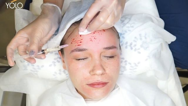 Полная процедура мезотерапии в технике наппаж