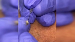 подборка выдавливания прыщей 24 II выдавливание прыщей