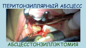 ПЕРИТОНЗИЛЛЯРНЫЙ АБСЦЕСС или ПАРАТОНЗИЛЛЯРНЫЙ АБСЦЕС АБСЦЕССТОНЗИЛЛЭКТОМИЯ. ВСКРЫТИЕ, лор операция