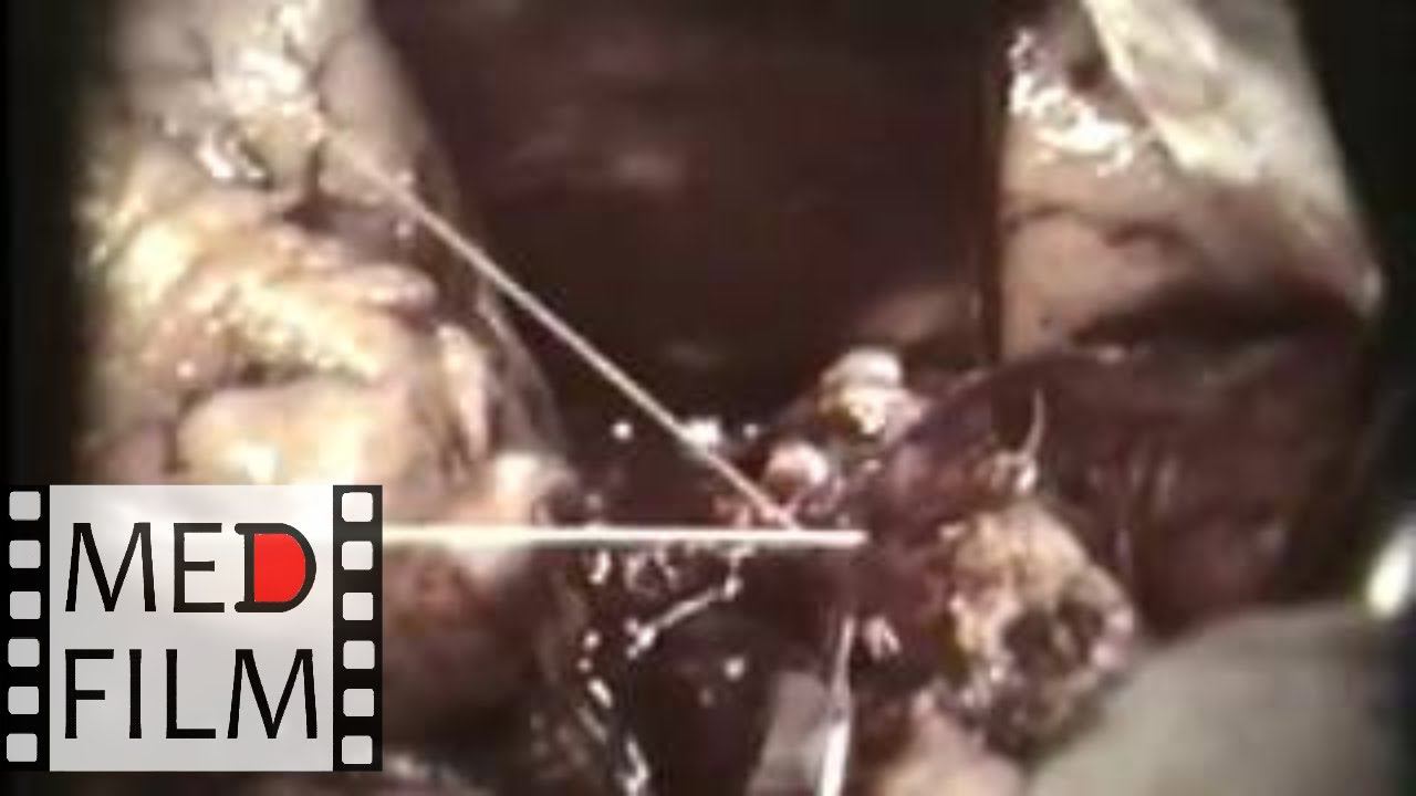 Резекция поджелудочной железы © Pancreatectomy