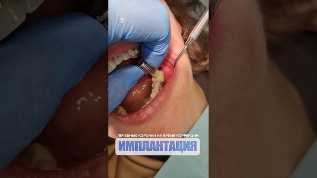 Лечебные коронки на время коррекции. Medical crowns for the time of correction. Implantation. смотреть онлайн