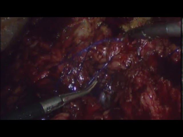Laparoscopic Or Endoscopic Subcutaneus Onlay Ventral Hernia Repair