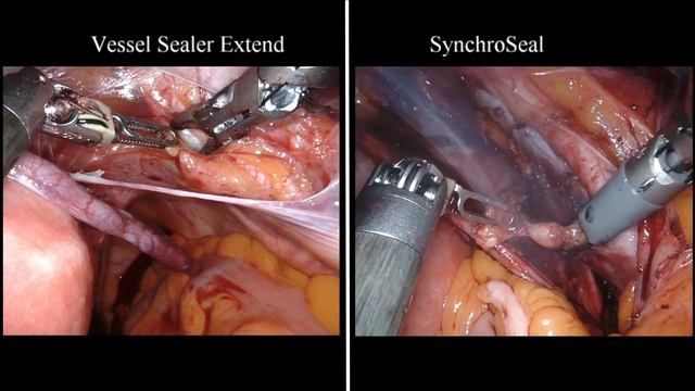 Robotic pelvic sentinel lymph node (SLN) dissection смотреть онлайн