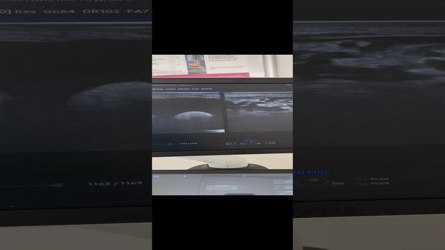 Рецидив варикоцеле. Водянка. Узи. Урология. Флеболог Москва смотреть онлайн