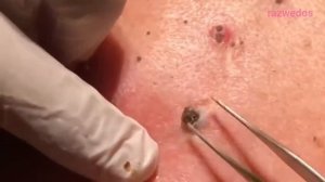 угри- Черные головы Извлечение Белые головы Удаление прыщей