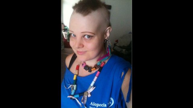 International Alopecia Day® 2014! смотреть онлайн