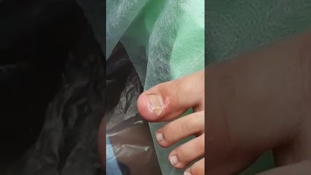 Лечение вросшего ногтя и установка скобы (видео 1) - Подолог Елена Баскова смотреть онлайн