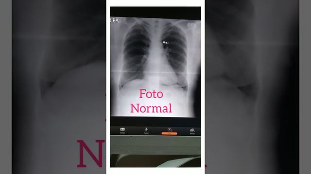 CARA MEMBEDAKAN ABNORMAL DAN NORMAL FOTO THORAX RONTGEN смотреть онлайн