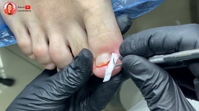 Удаление вросшего ногтя смотреть онлайн