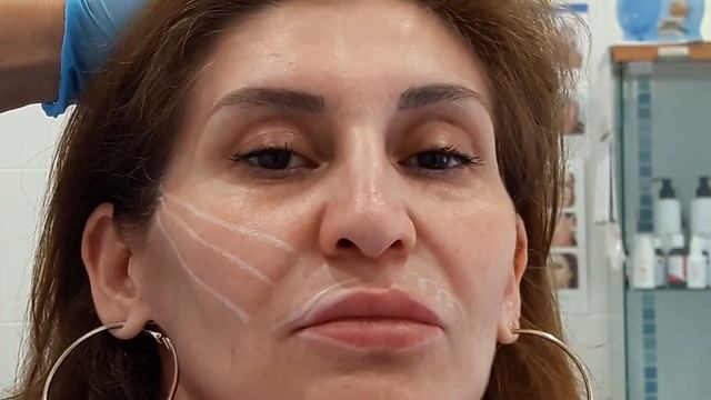 МЕЗОНИТИ: подготовка к процедуре (разметка), введение мезонитей.