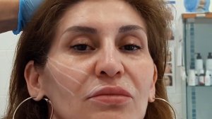 МЕЗОНИТИ: подготовка к процедуре (разметка), введение мезонитей.