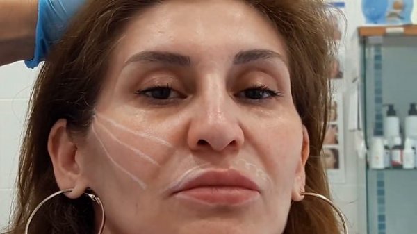 МЕЗОНИТИ: подготовка к процедуре (разметка), введение мезонитей.