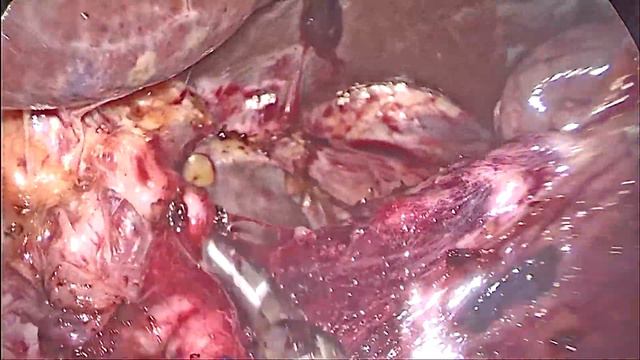 Лапароскопическая дистальная субтотальная резекция желудка с D2 лимфодиссекцией.