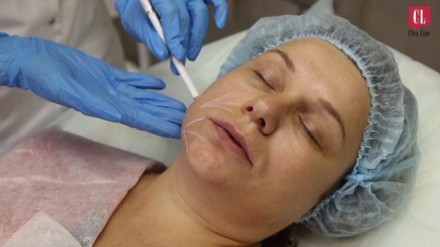 Демонстрация процедуры Векторный лифтинг Радиесс смотреть онлайн