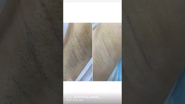 Лазерная Эпиляция смотреть онлайн