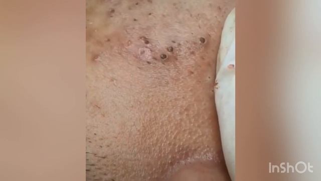 Big blackheads | Давим черные точки и прыщи смотреть онлайн