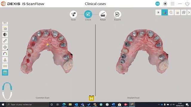 Digitize and accelerate your workflow with DEXIS intraoral scanners смотреть онлайн
