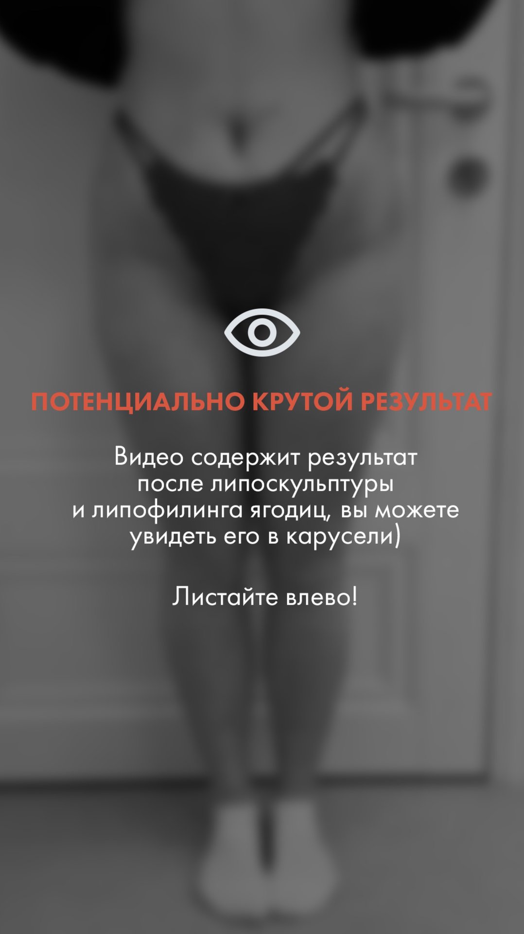 Результаты липоскульптуры и липофилинга ягодиц