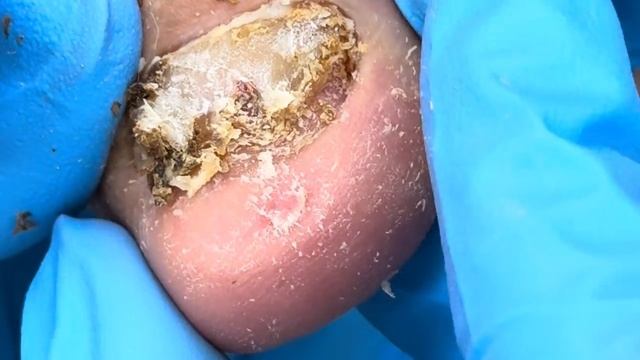 Very dirty nails! A thick layer of black mud is on the nails【Doctor Liu Pedicure】 смотреть онлайн