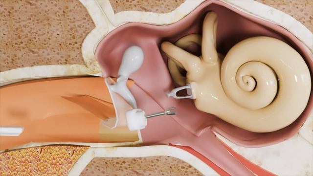 Incus Replacement - Partial Ossicular Replacement Prosthesis (I-PORP) for Hearing Loss смотреть онлайн