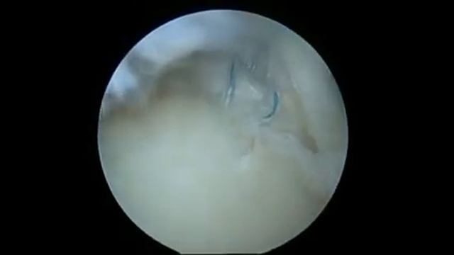 SLAP repair : shoulder superior anteior labrum repair смотреть онлайн