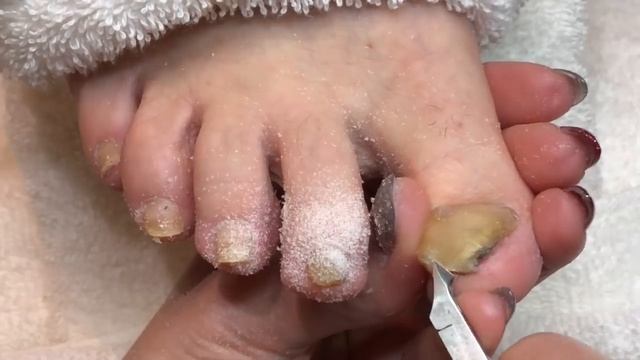 ? How To Pedicure Cut And Shape Thick Toenails With Nail Fungus ?