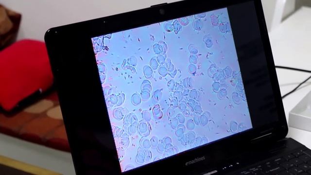 Гемосканирование с помощью темнопольного микроскопа смотреть онлайн
