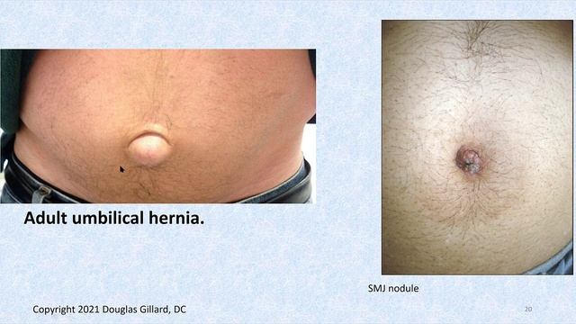 Abdominal Exam: Inspection - Learn about Cullen's & Grey Turner's sign, & Sister Mary Joseph nodule смотреть онлайн