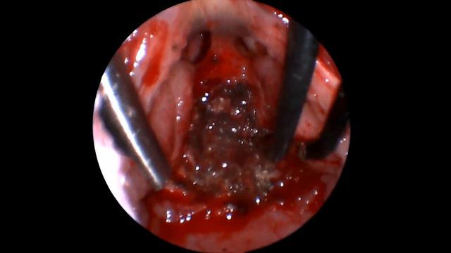 Эндоскопическая шейверная #аденотомия Аденоидные вегетации 3й степени #лорврач #аденоиды #гайморит смотреть онлайн