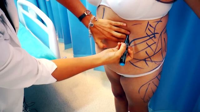 LIPOABDOMINOPLASTÍA (DRA. MARÍA DEL CARMEN MARTÍNEZ - MARÍA ELIZABETH) смотреть онлайн