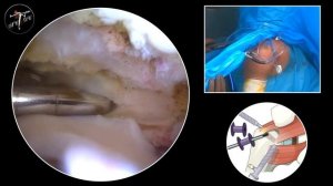 Большой разрыв вращательной манжеты, двухрядная техника, тенодез бицепса, шов подлопаточной мышцы