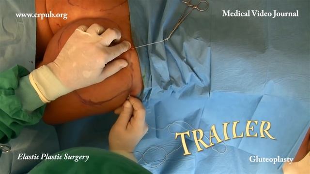 24. Lifting of the buttocks with the elastic thread through two 5 mm incisions смотреть онлайн