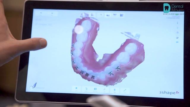 Review of the 3Shape Trios Move - new intraoral dental scanner смотреть онлайн
