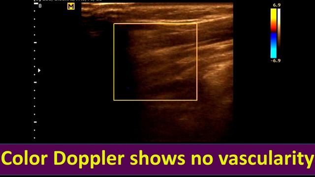 Neck Mass | Cervical Lymph node | Cervical Lymphadenopathy | Neck Ultrasonography смотреть онлайн