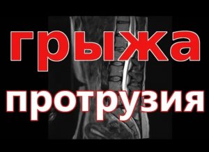 Грыжа межпозвоночная, как лечить без операции.mp4
